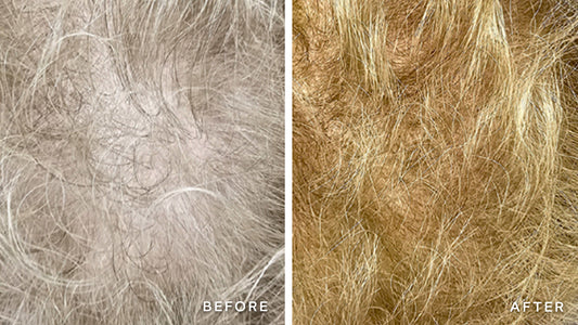 Understanding Female Hair Loss