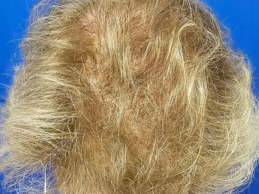 After: Month Two (Day 60) — 64 Year-Old Female. Daily Use Hair Growth Gummies