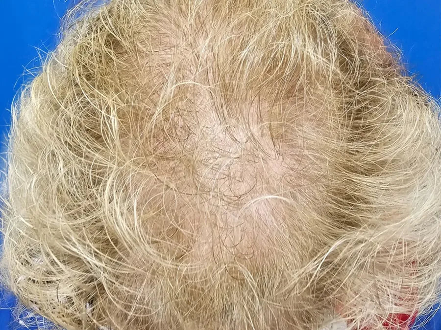 Before: Baseline (Day 0) — 64 Year-Old Female. Daily Use Hair Growth Gummies
