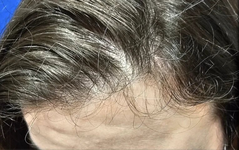 After: Month Two (Day 60) — 43 Year-Old Female. Daily Use Hair Growth Gummies