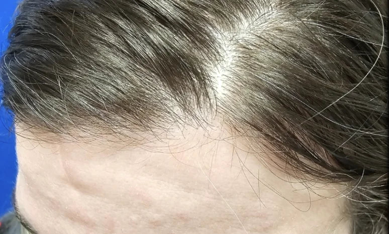 Before: Baseline (Day 0) — 43 Year-Old Female. Daily Use Hair Growth Gummies