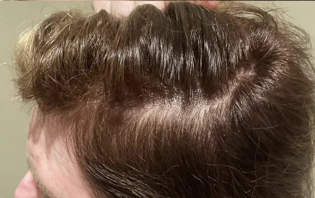 After: Month Three — 52 Year-Old Female. Daily Use Hair Growth Gummies