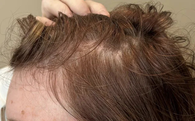 Before: Baseline (Day 0) — 52 Year-Old Female. Daily Use Hair Growth Gummies